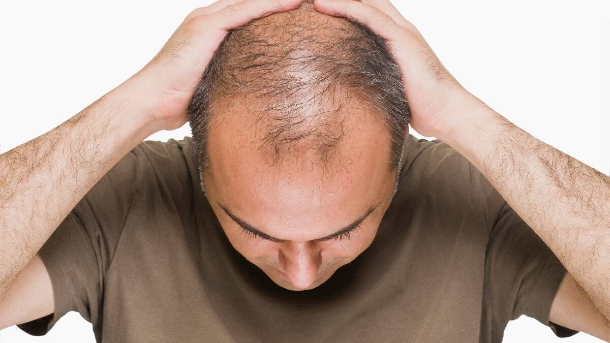 Fighting Male Pattern Baldness